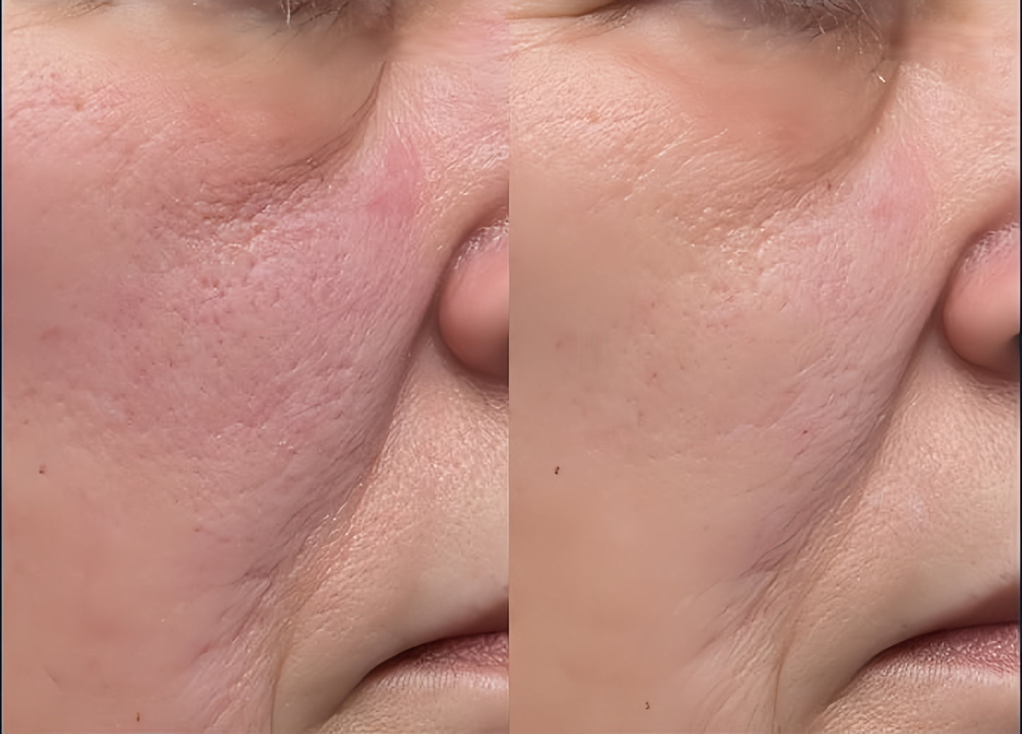 DYNAMIC RESURFACINGFACIAL PADS